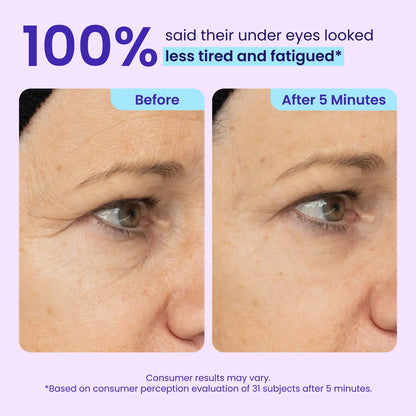 💎Mother's Birthday Gift💓-Erase Eye Bags in Minutes — Look Refreshed Instantly