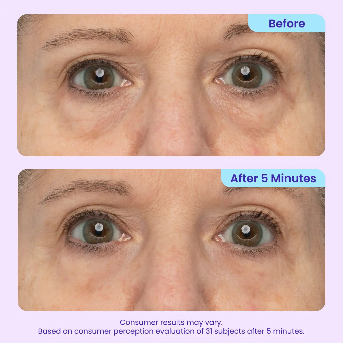 💎Mother's Birthday Gift💓-Erase Eye Bags in Minutes — Look Refreshed Instantly